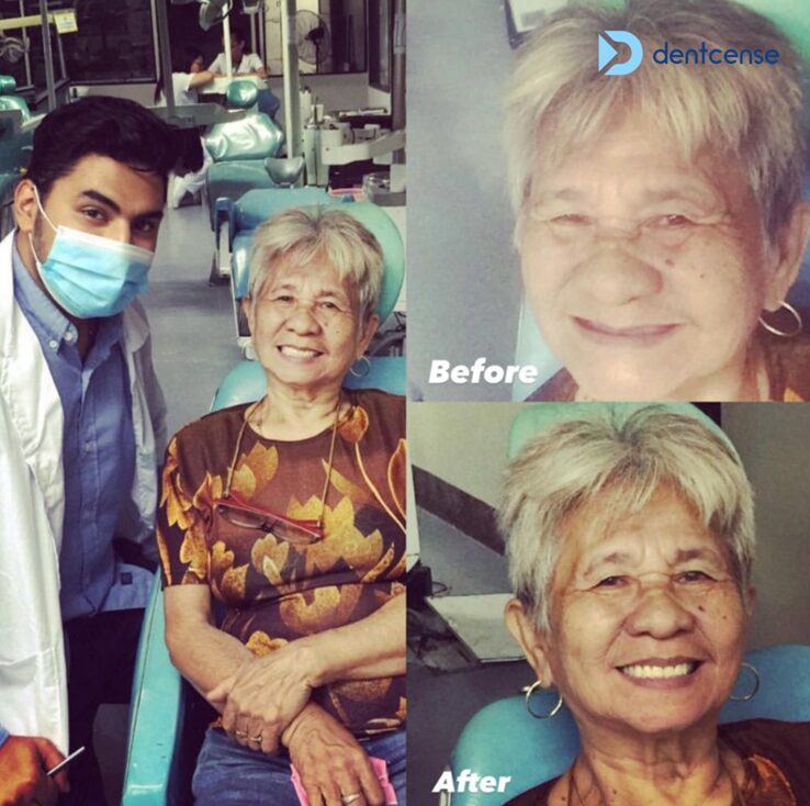 Dentcense treatment