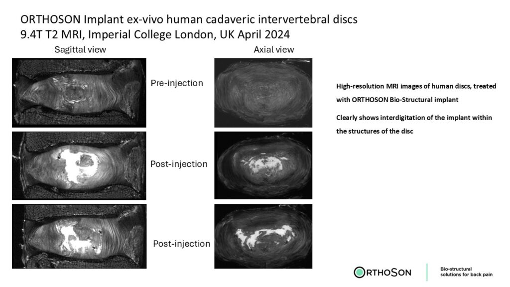 High-resolution MRI images of human discs, treated with ORTHOSON Bio-Structural implant

