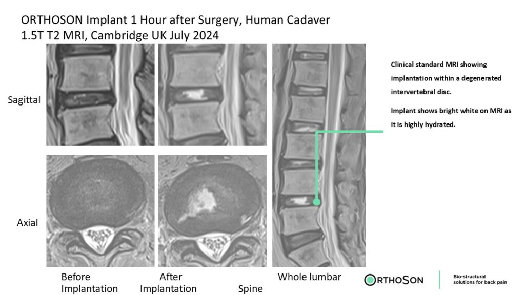 ORTHOSON Implant 1 Hour after Surgery